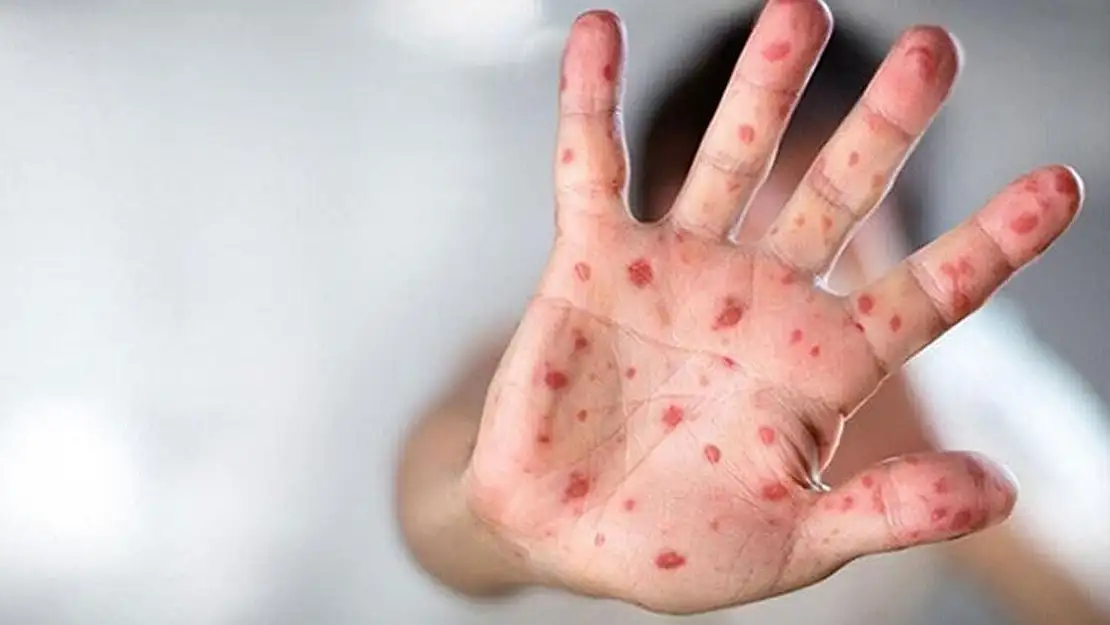 Sağlık Bakanlığı M-çiçeği (MPOX) rehberi yayımladı